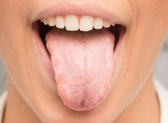 Απίστευτο: Aρχισαν να φυτρώνουν μαύρες τρίχες στη γλώσσα αυτής της γυναίκας μετά από τροχαίο -Η εικόνα που σόκαρε τους γιατρούς