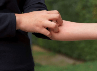 Γιατί κάποιους τους τσιμπούν τα κουνούπια και άλλους όχι