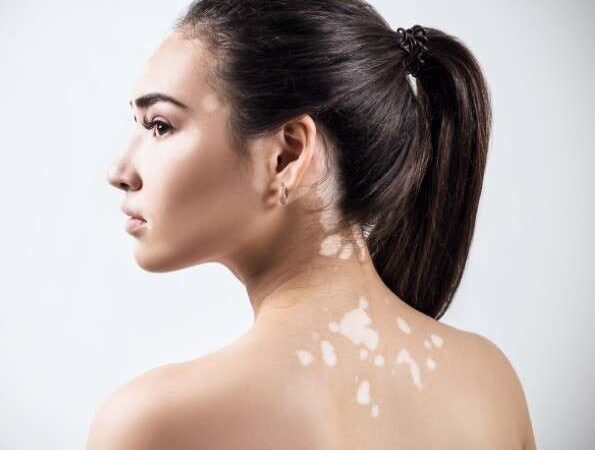 Η λεύκη στο δέρμα θεραπεύεται!