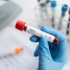 Επιστήμονες μαθαίνουν να ελέγχουν τον HIV χωρίς φάρμακα: Νέα ελπίδα στην αντιμετώπιση του AIDS